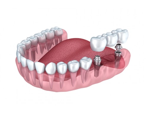 Dental Implants Austin TX